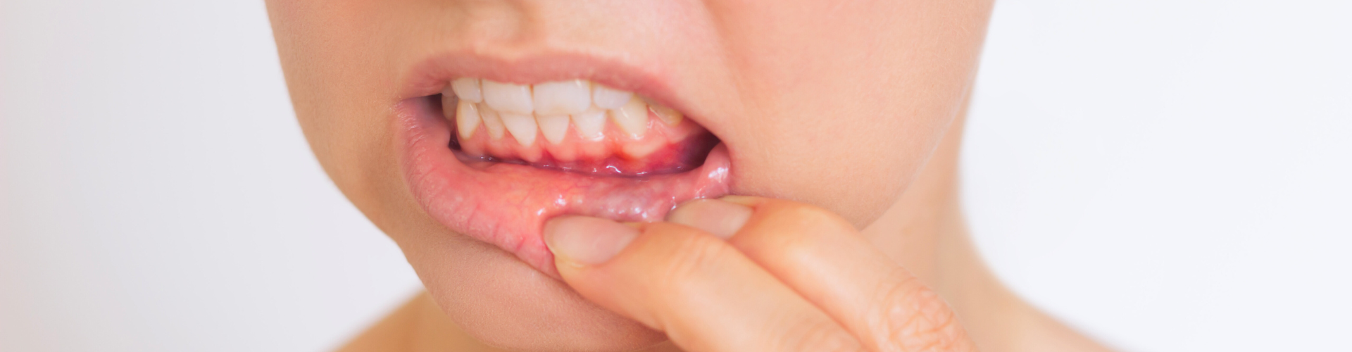Woman pulling down lower lip to reveal inflamed gums.